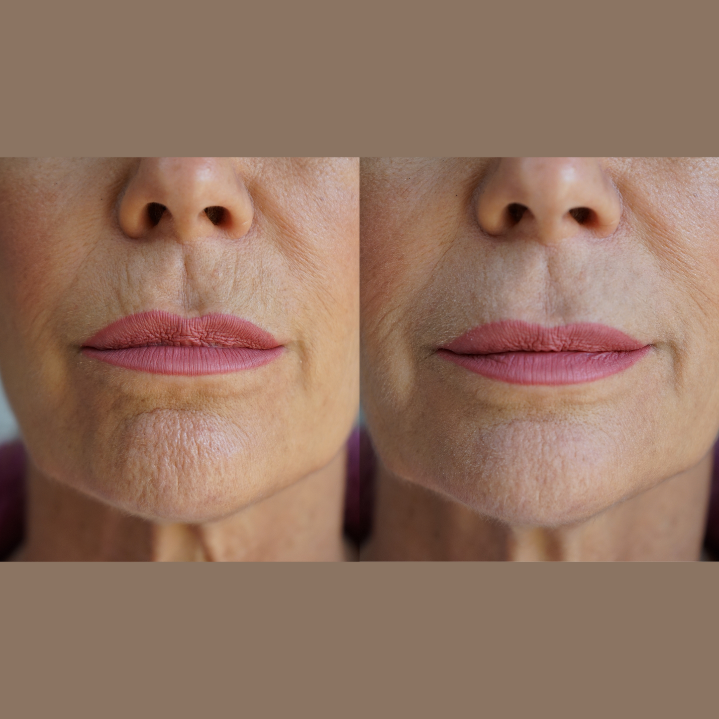 Ageless Lip & Line Filler