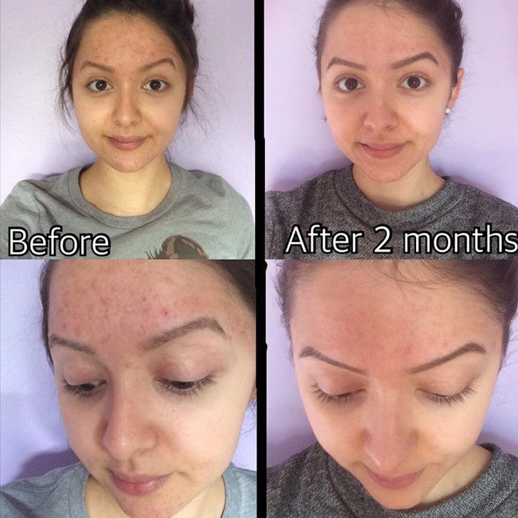 Before and after comparison of a woman's face with text indicating time elapsed.