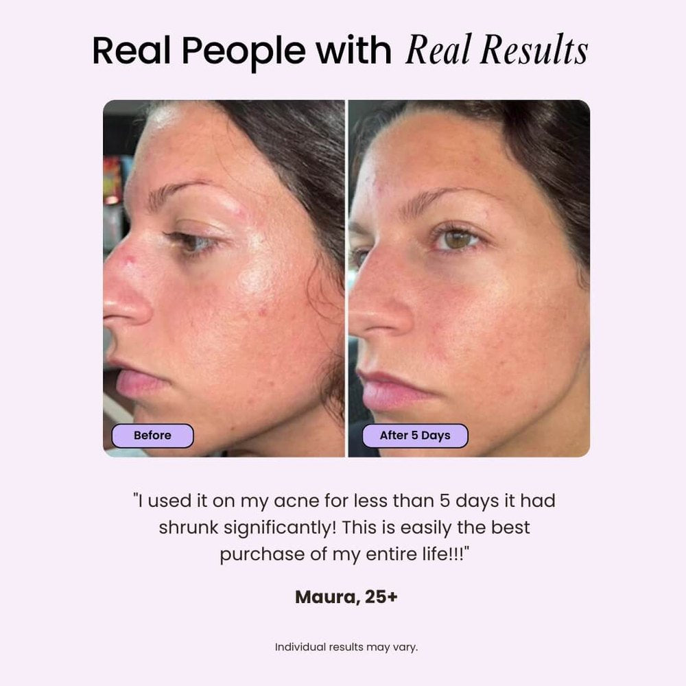 Before and after comparison of a person's face with text about real results and a customer review.