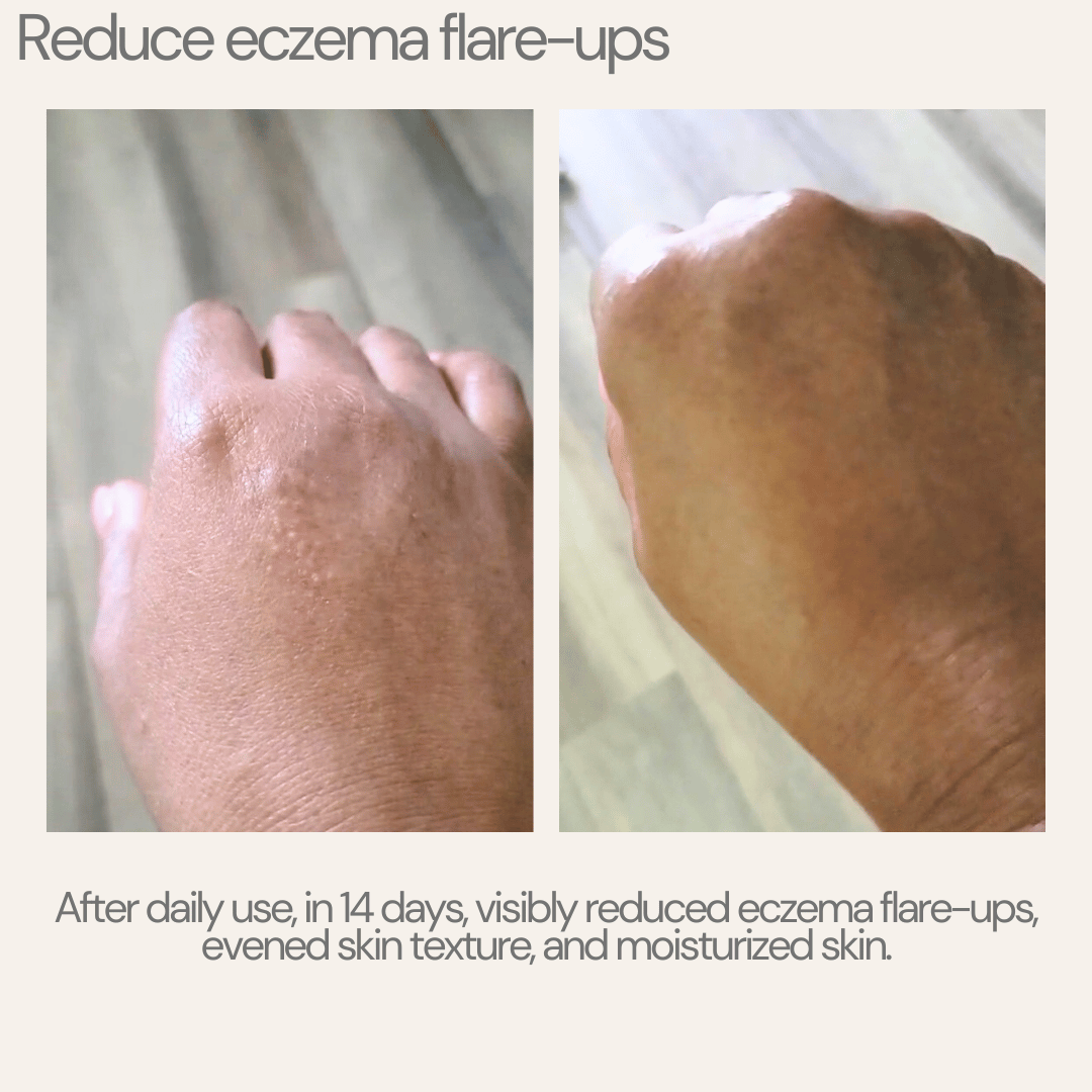 Before and after comparison of eczema flare-ups on skin with text about product effects.