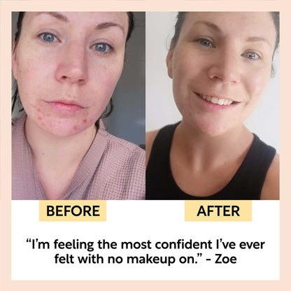Before and after comparison of a person with acne and clear skin, featuring text from Zoe.
