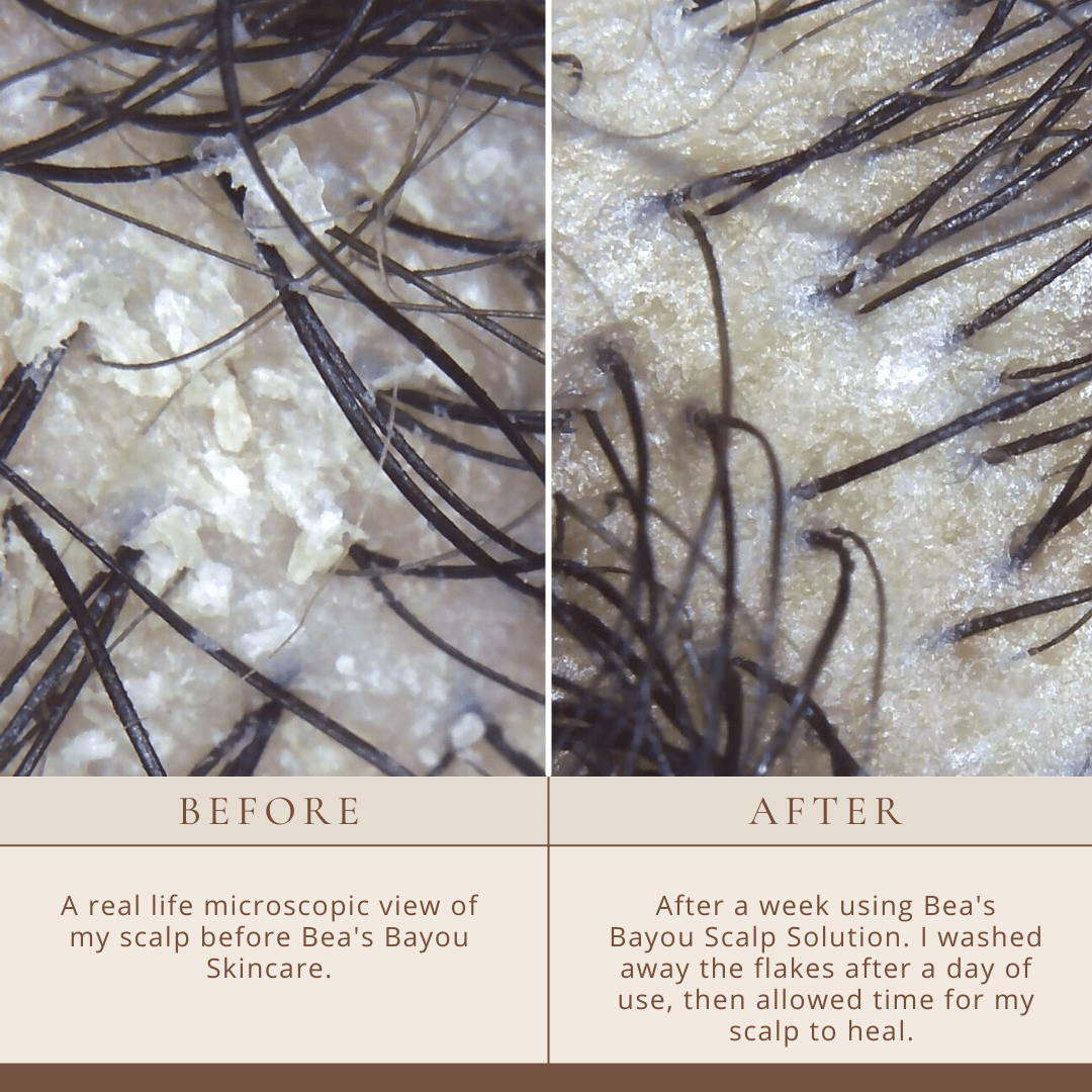 Seborrheic Itchy Scalp Solution | Herbal Probiotic Leave-in