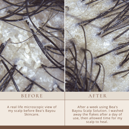 Seborrheic Itchy Scalp Solution | Herbal Probiotic Leave-in